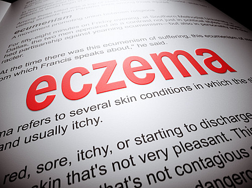 Harvard Health Ad Watch: A new injection treatment for eczema featured image