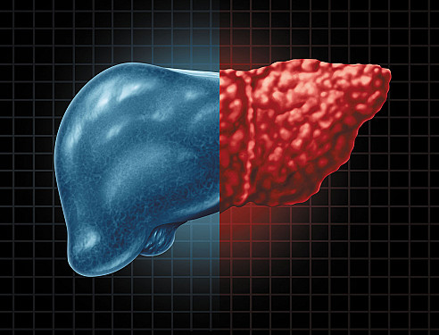The skinny on fatty liver featured image