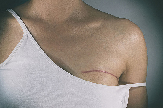 Women lack information on life after breast reconstruction featured image