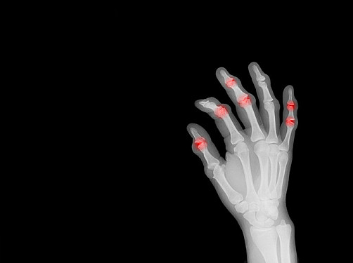 Treatments for rheumatoid arthritis may lower dementia risk featured image