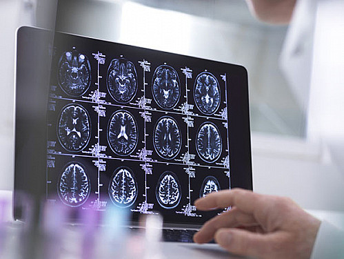LATE: A common cause of dementia you've never heard of featured image