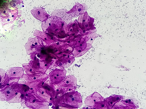Late-stage cervical cancer on the rise: What to know featured image