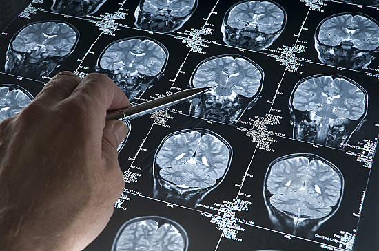 A new Alzheimer’s drug: From advisory panel to FDA — what’s at stake here? featured image
